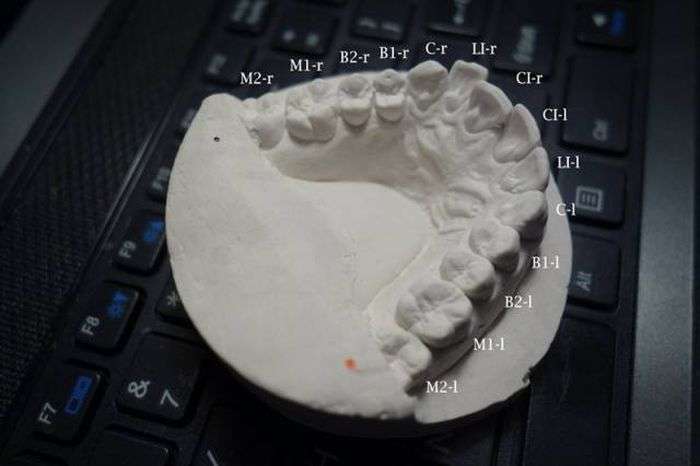 Хлопець вирівняв зуби за допомогою саморобних брекетів, надруковані на 3D-принтері (11 фото)