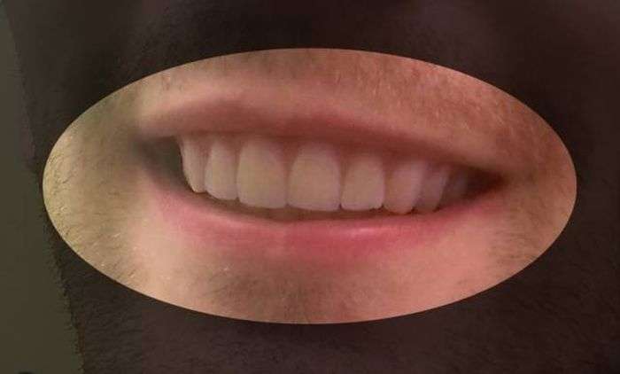 Хлопець вирівняв зуби за допомогою саморобних брекетів, надруковані на 3D-принтері (11 фото)